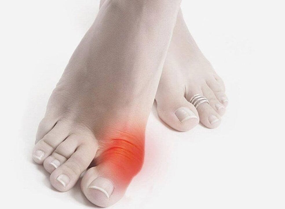 Fußsymptome der Gicht